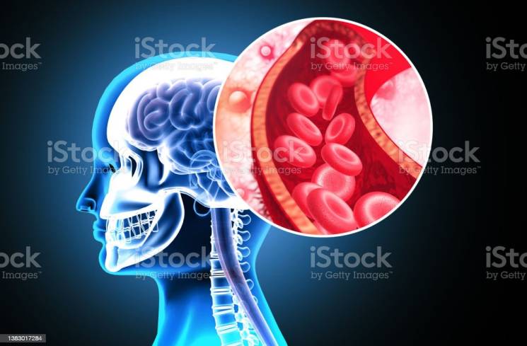 ilustrasi gambar serangan stroke.